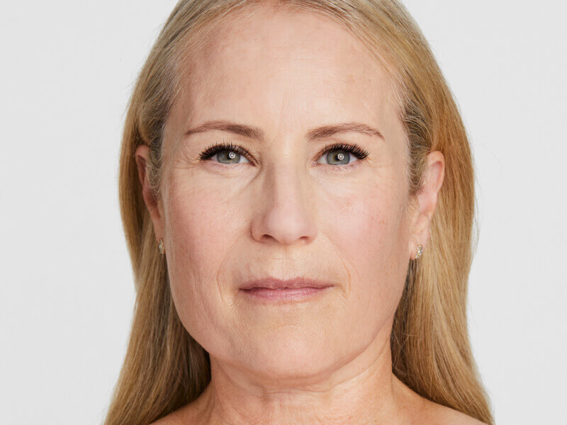 resultados de tratamientos esteticos